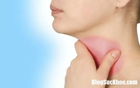 Dùng nhiều thuốc kháng sinh trị viêm họng lâu ngày gây suy tim