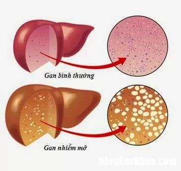 Gan nhiễm mỡ không chỉ có người người lớn mới bị