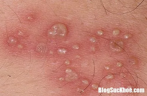Bệnh sùi mào gà và mối nguy hiểm khôn cùng