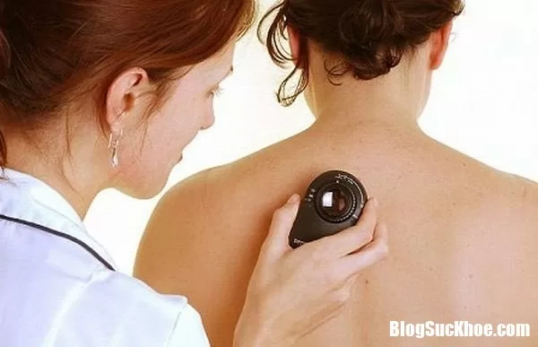 Những thói quen không ngờ khiến bạn bị ung thư da
