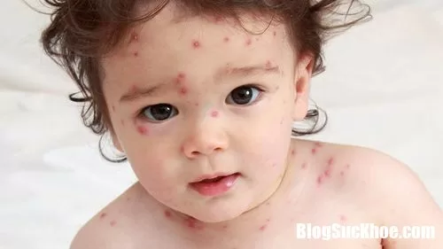 Cách nhận biết trẻ mắc bệnh thủy đậu