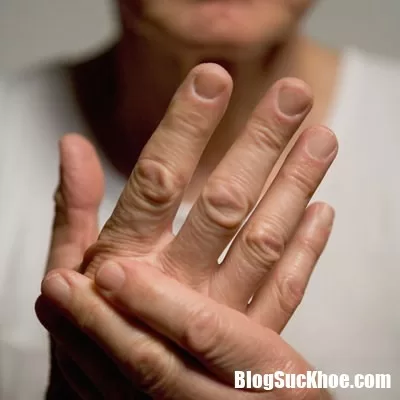 Bệnh viêm khớp vẩy nến nguyên nhân do đâu ?
