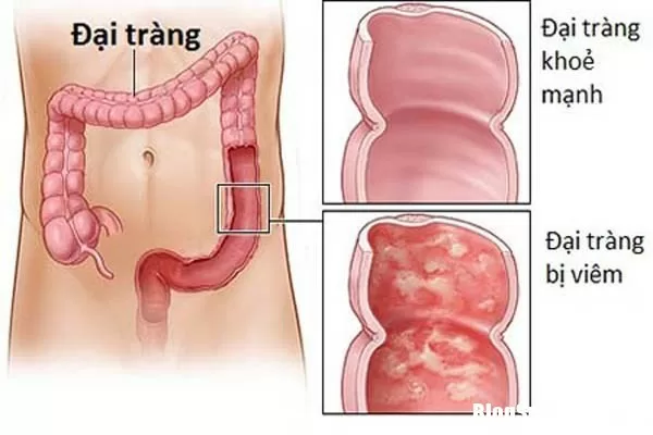 Viêm đại tràng mãn tính - Nguyên nhân do đâu ?