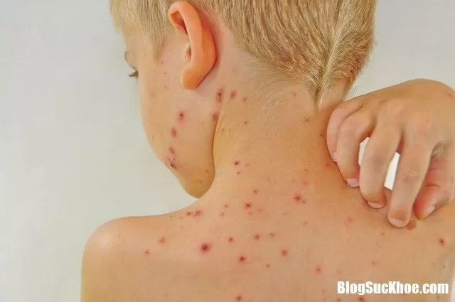 Những loại dị ứng trẻ dễ gặp vào mùa hè