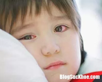 Bị đau mắt đỏ nên tránh xa những món này để bảo vệ mắt