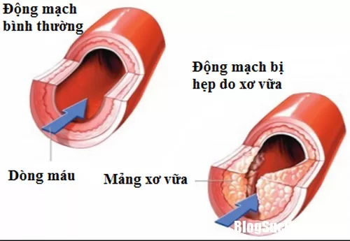 Những cách đơn giản ngừa mảng bám xơ vữa động mạch