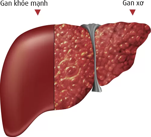 Chế độ ăn uống dành cho bệnh nhân xơ gan