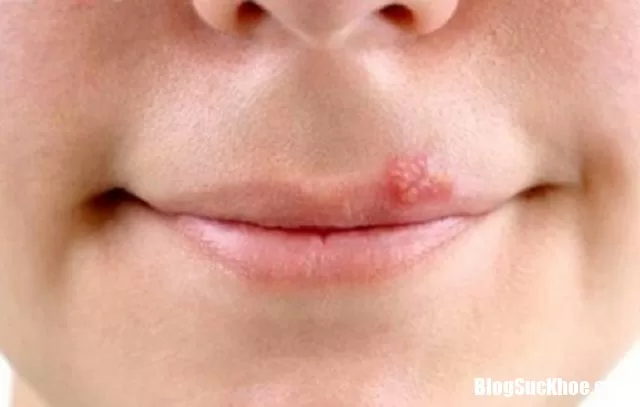 Mẹo dân gian trị lở miệng cực hay