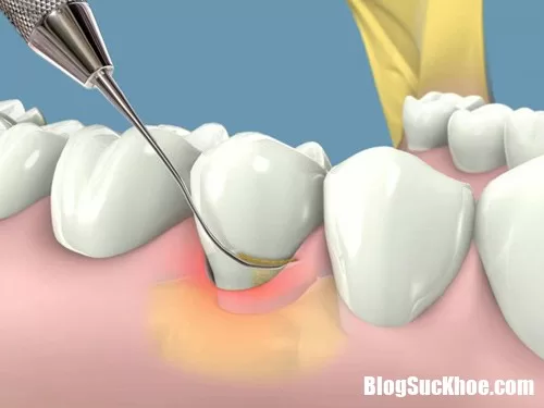 Viêm lợi, chảy máu chân răng đã có mẹo này thì không cần đến thuốc