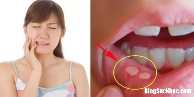 Những nguyên nhân gây nhiệt miệng ít người biết đến