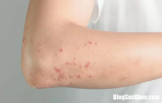 Vì sao lại bị phát ban ?