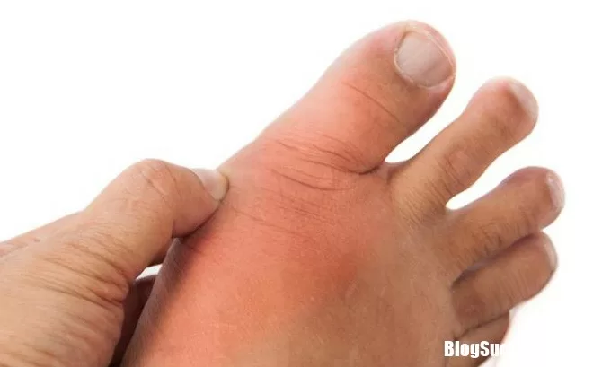 Bệnh nhân gút nên hạn chế ăn những thực phẩm
