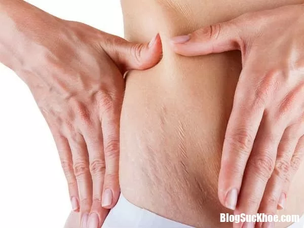 Xóa sạch vết rạn da cứng đầu bằng những mẹo cực đơn giản