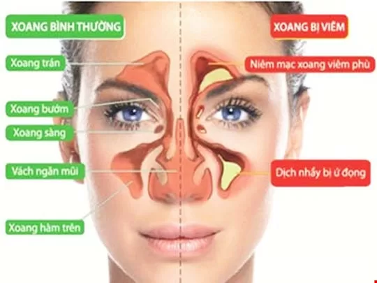 Những kiến thức căn bản của bệnh viêm xoang