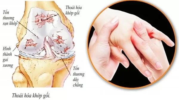 Cách tập luyện bệnh đau khớp ở người cao tuổi