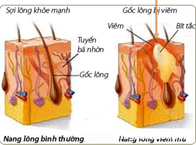 Bệnh ngoài da mùa mưa lũ và cách dùng thuốc đặc trị