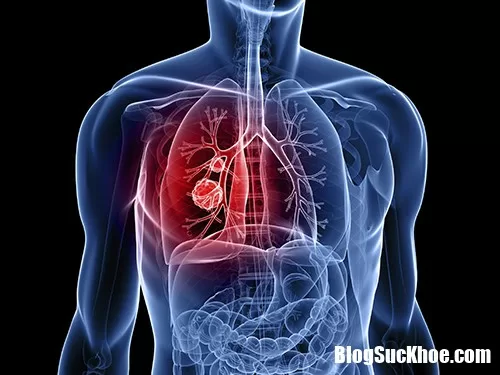 Những thực phẩm cần kiêng kị khi bị ung thư phổi