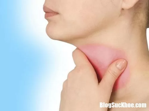 Viêm thanh quản - nguy hiểm hơn chúng ta vẫn tưởng nhiều