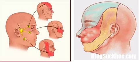 Vì sao hay dễ chẩn đoán nhầm đau dây thần kinh số V ?