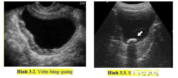 Nguyên nhân và cách phòng ngừa viêm bàng quang cấp tính
