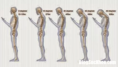 Đau cột sống cổ đang ngày càng trẻ hóa là do những thói quen xấu này