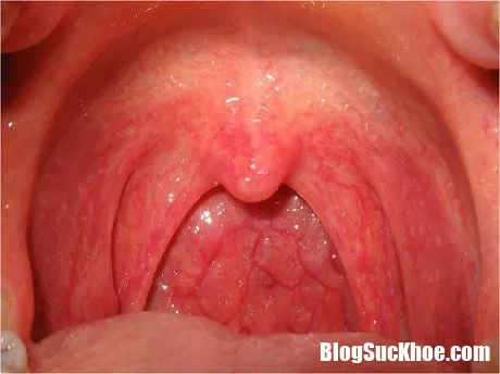 Viêm họng cấp khi giao mùa chớ nên coi thường