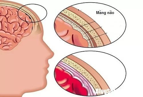 Những dấu hiệu ít ai ngờ cửa bệnh viêm màng não