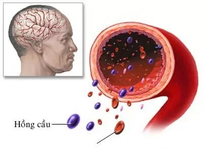 Lưu ý khi dùng thuốc trị đau nửa đầu