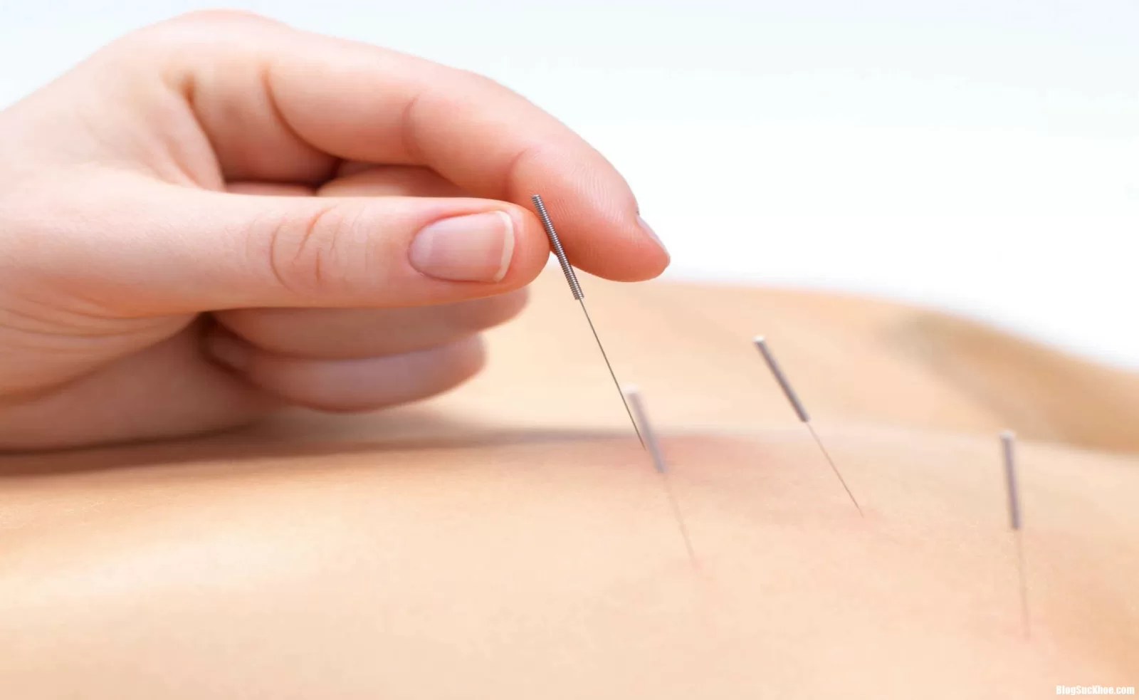 Sơ cứu đột quỵ bằng châm cứu, bấm huyệt nên hay không nên ?