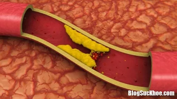Người trẻ thiếu cholesterol dễ bị đau tim, đột quỵ
