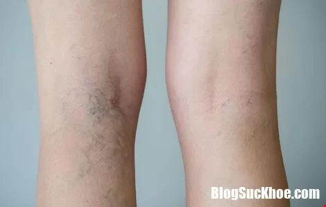 Tìm hiểu về suy tĩnh mạch chân