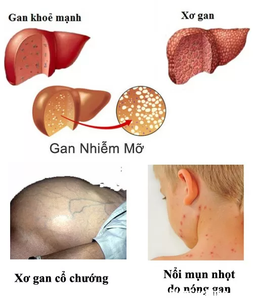 Những biểu hiện nóng gan và hệ lụy