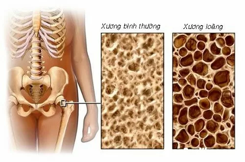 Dấu hiệu nhận biết loãng xương cần quan tâm