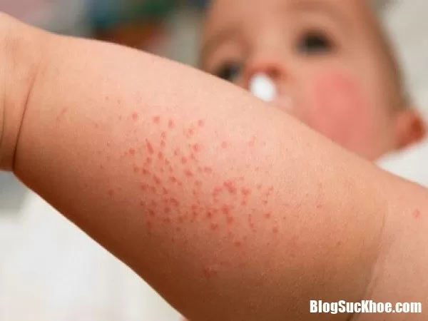 Dấu hiệu nhận biết sốt xuất huyết sớm nhất chớ nên bỏ qua