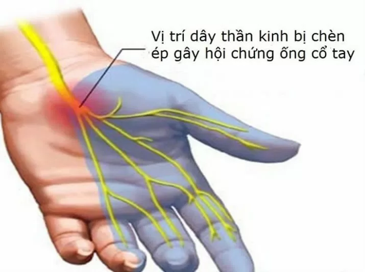 Hội chứng ống cổ tay xuất hiện phổ biến với dân văn phòng