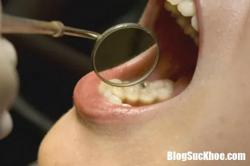 Người có tiền sử bệnh nướu răng có nguy cơ mắc ung thư