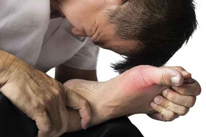 Các triệu chứng của bệnh gout dễ nhận thấy