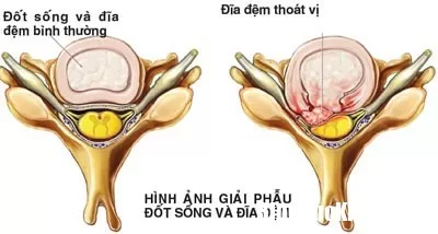 Bệnh thoát vị đĩa đệm khi nào là nguy hiểm nhất ?