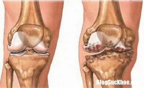 Nguyên nhân và cách phòng ngừa khô khớp xương