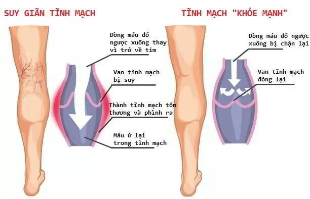 Dân văn phòng có nguy cơ mắc suy giãn tĩnh mạch cao