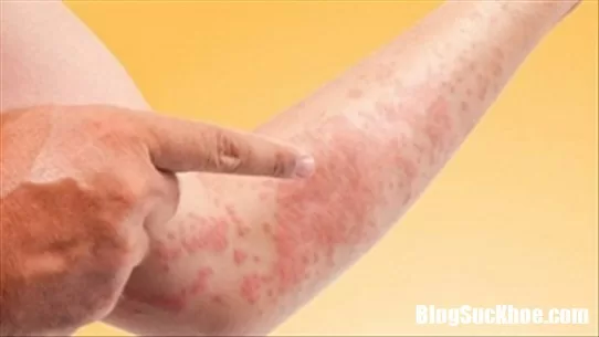 Dị ứng thực phẩm có nguy hiểm đến tính mạng không ?