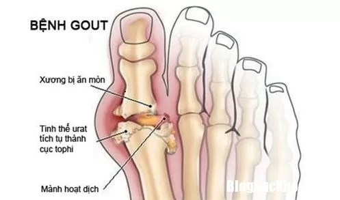 Những dấu hiệu bệnh gout không nên thờ ơ