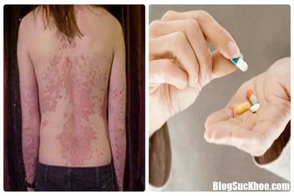 Nguy cơ tử vong do sử dụng thuốc không đúng khi mắc bệnh lupus ban đỏ