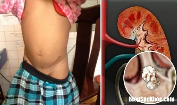 Uống nước cam sai cách, mẹ khiến con bị sỏi thận