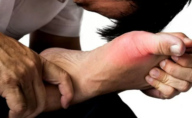 Mẹo hay giúp chế ngự cơn đau do bệnh Gout.
