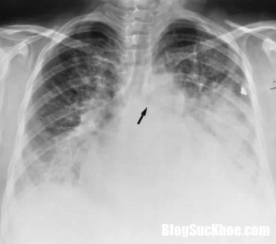 Những triệu chứng đầu tiên của bệnh phù phổi