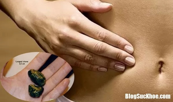 Nếu có những dấu hiệu này có thể bạn đã bị sỏi mật cần đi khám ngay