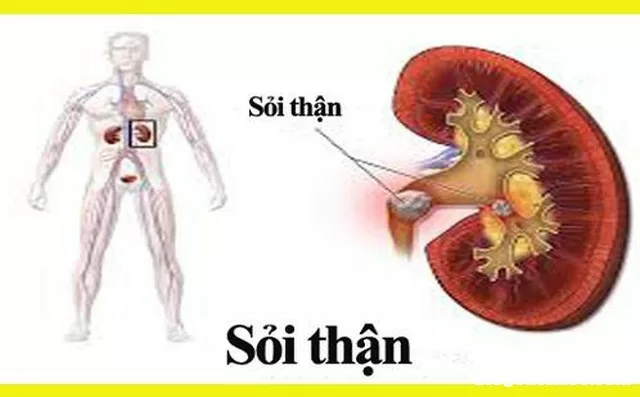 Những thói quen ăn uống không hợp lý của người Việt là nguyên nhân gây bệnh sỏi thận