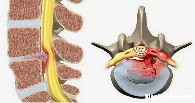 Những thói quen sai gây nên thoát vị đĩa đệm