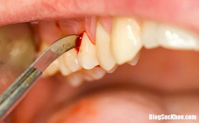 Những dấu hiệu cảnh báo ung thư từ răng cần đi khám ngay